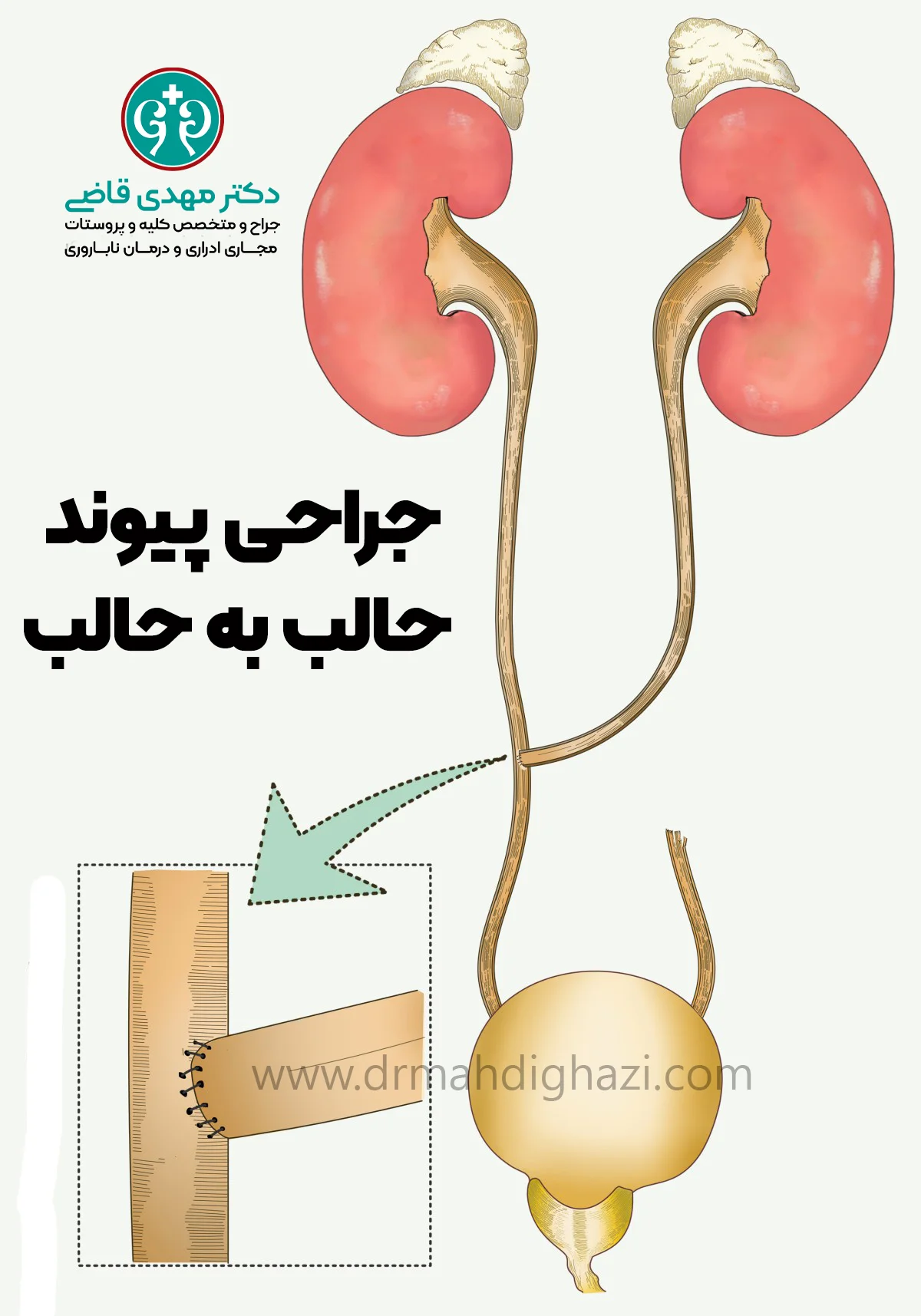دکتر مهدی قاض - درمان های جراحی برای بسته شدن حالب