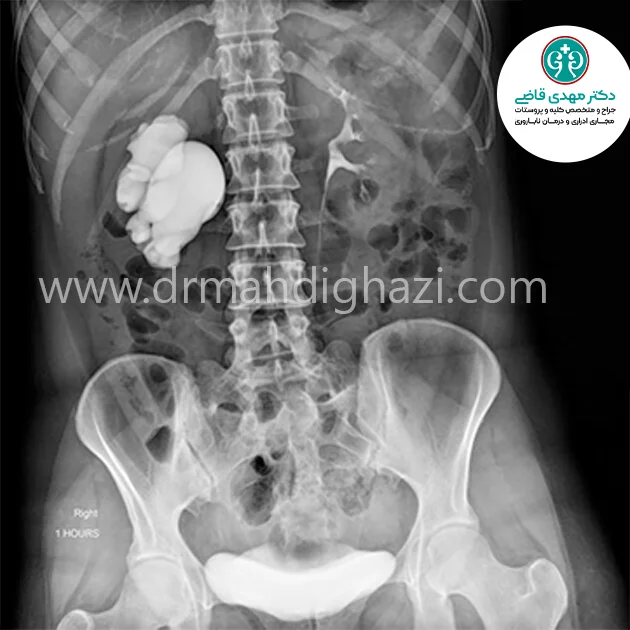 دکتر قاضی -تنگی مجاری ادرار- درمان
