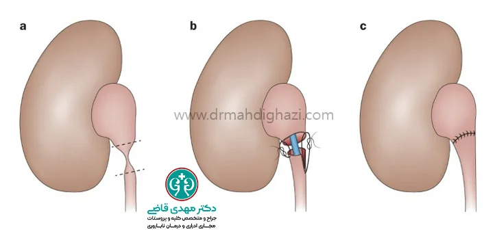 دکتر قاضی تنگی مجرای ادرار