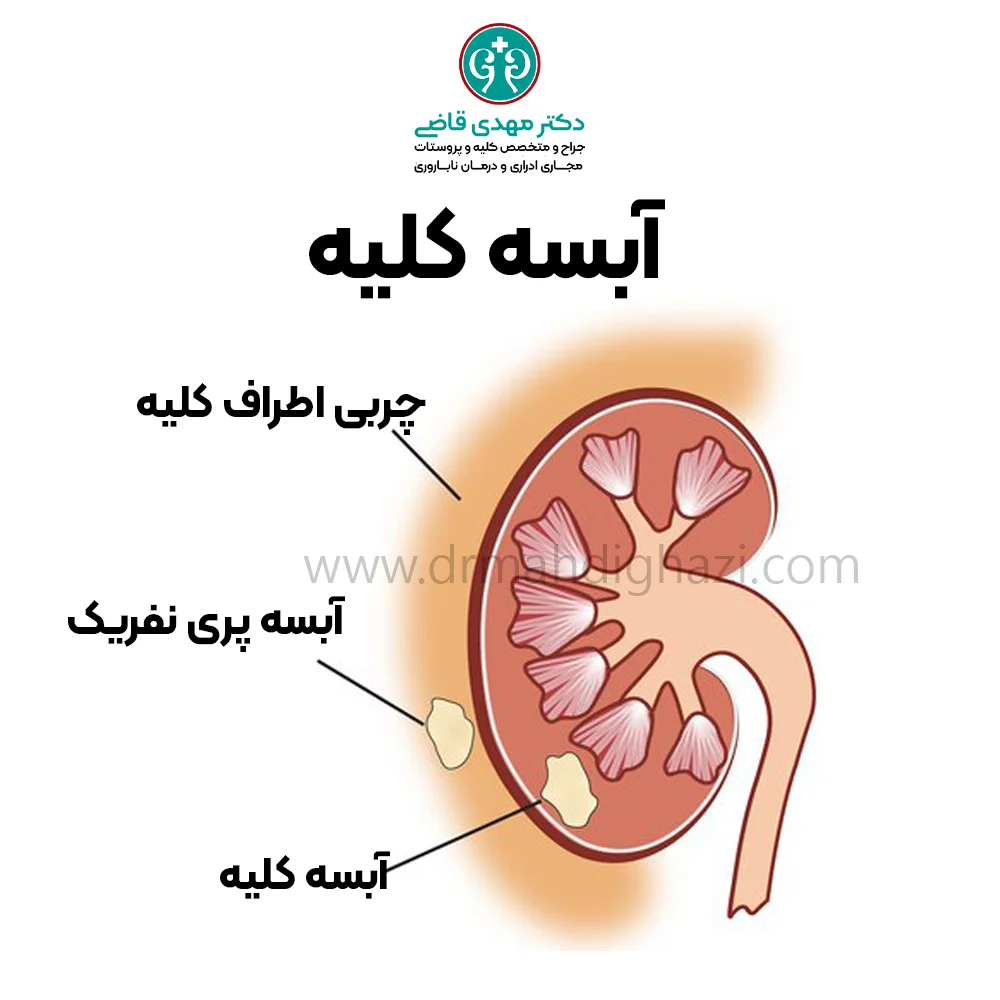 دکتر قاضی آبسه کلیه درمان و علت