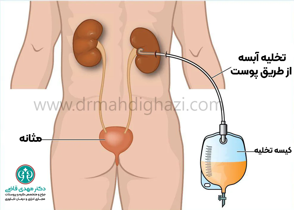 دکتر قاضی علل و درمان آبسه کلیوی