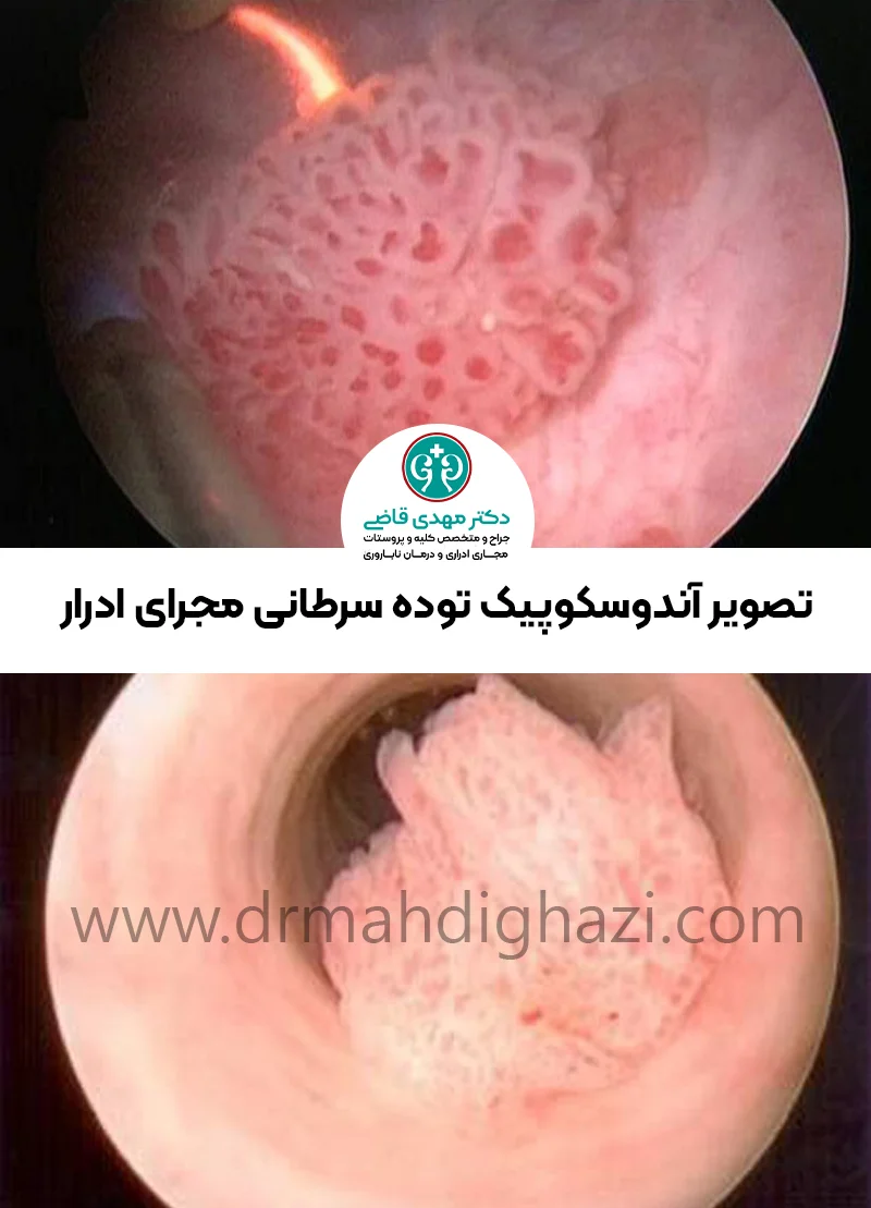 دکتر قاضی- تصویر برداری آندوسکوپیک توده سرطانی مجاری ادرار
