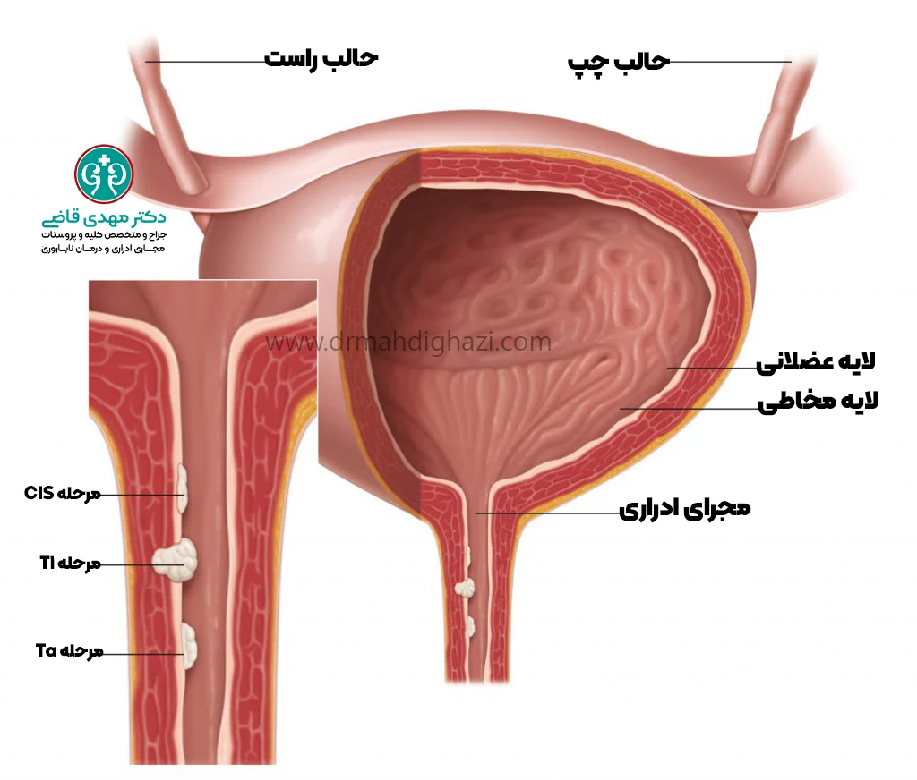 دکتر قاضی- درجه بندی و مرحله بندی سرطان پیشابراه