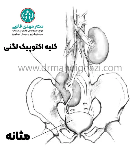 دکتر قاضی- تشخیص اکتوپی کلیه