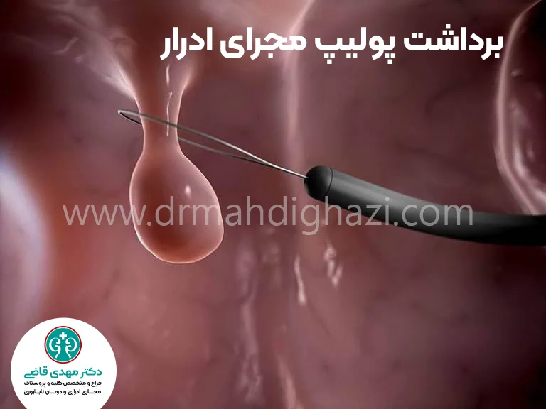 دکتر قاضی-• پیشگیری از عوارض تودههای خوش خیم مجرای ادرار در دختران-• مراقبتهای پس از جراحی پولیپ مجرای ادرار