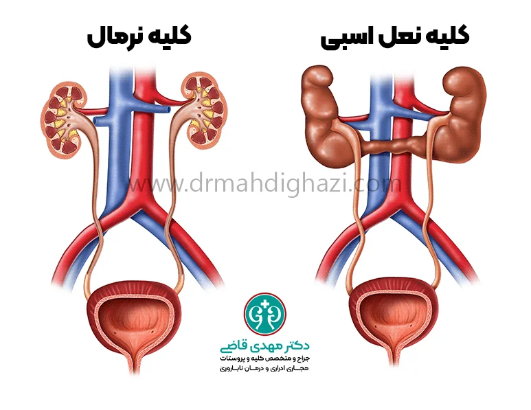 دکتر قاضی-علت کلیه نعل اسبی