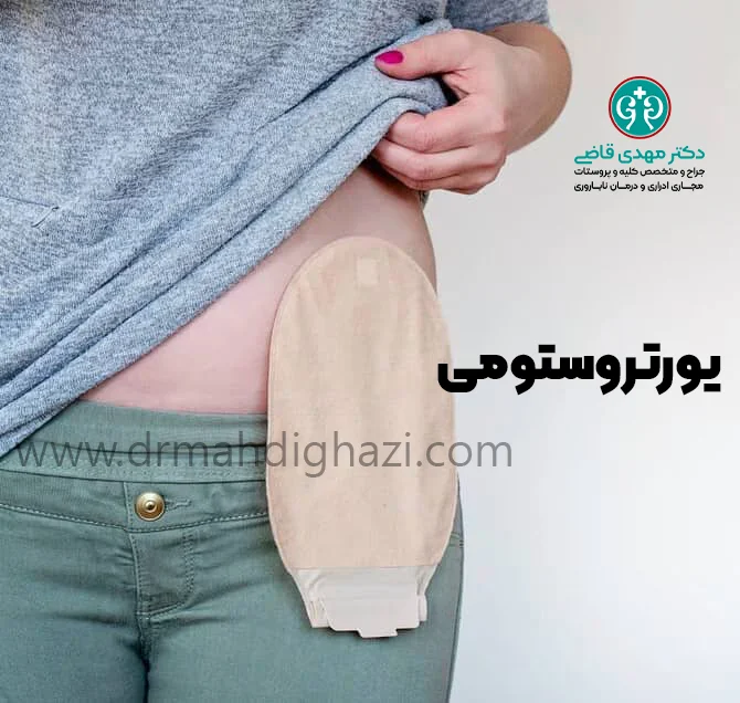 دکتر قاضی-مزایا و معایب دایورژن ادراری