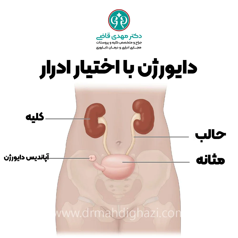 دکتر قاضی -مراقبت‌های پس از جراحی دایورژن ادرار