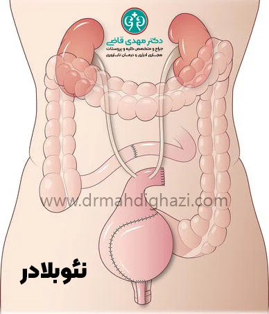 دکتر قاضی-دایورژن ادراری
