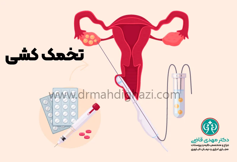 دکتر قاضی-• IVF • لقاح مصنوعی