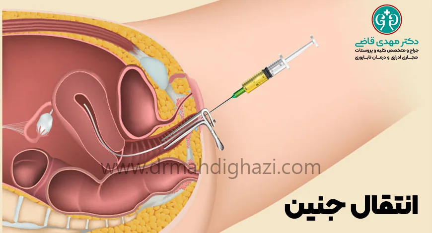دکتر قاضی- تکنیک‌های IVF