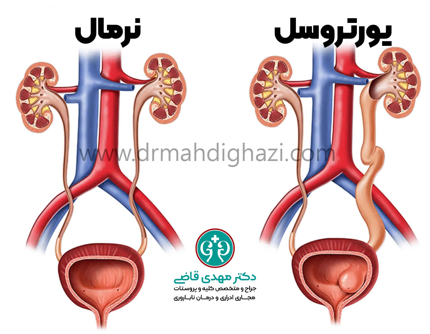 دکتر قاضی-تشخیص یورتروسل