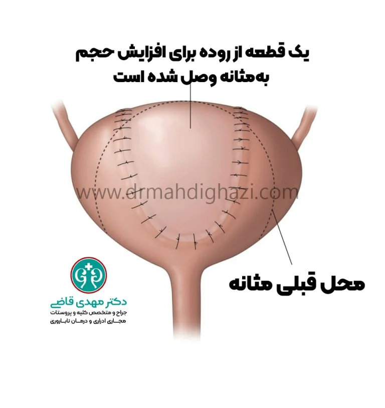 جراحی افزایش حجم مثانه (سیستوپلاستی)