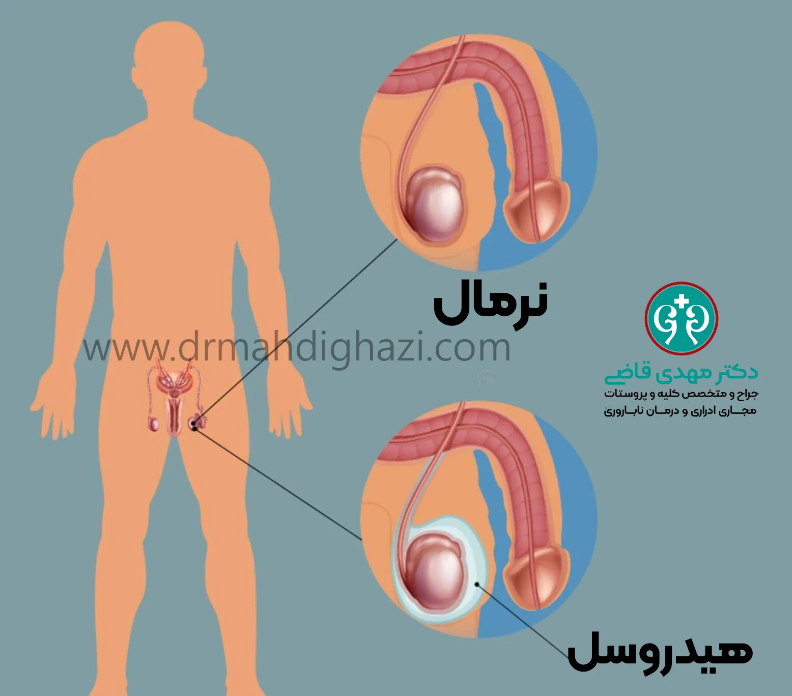 دکتر قاضی- علائم هیدروسل