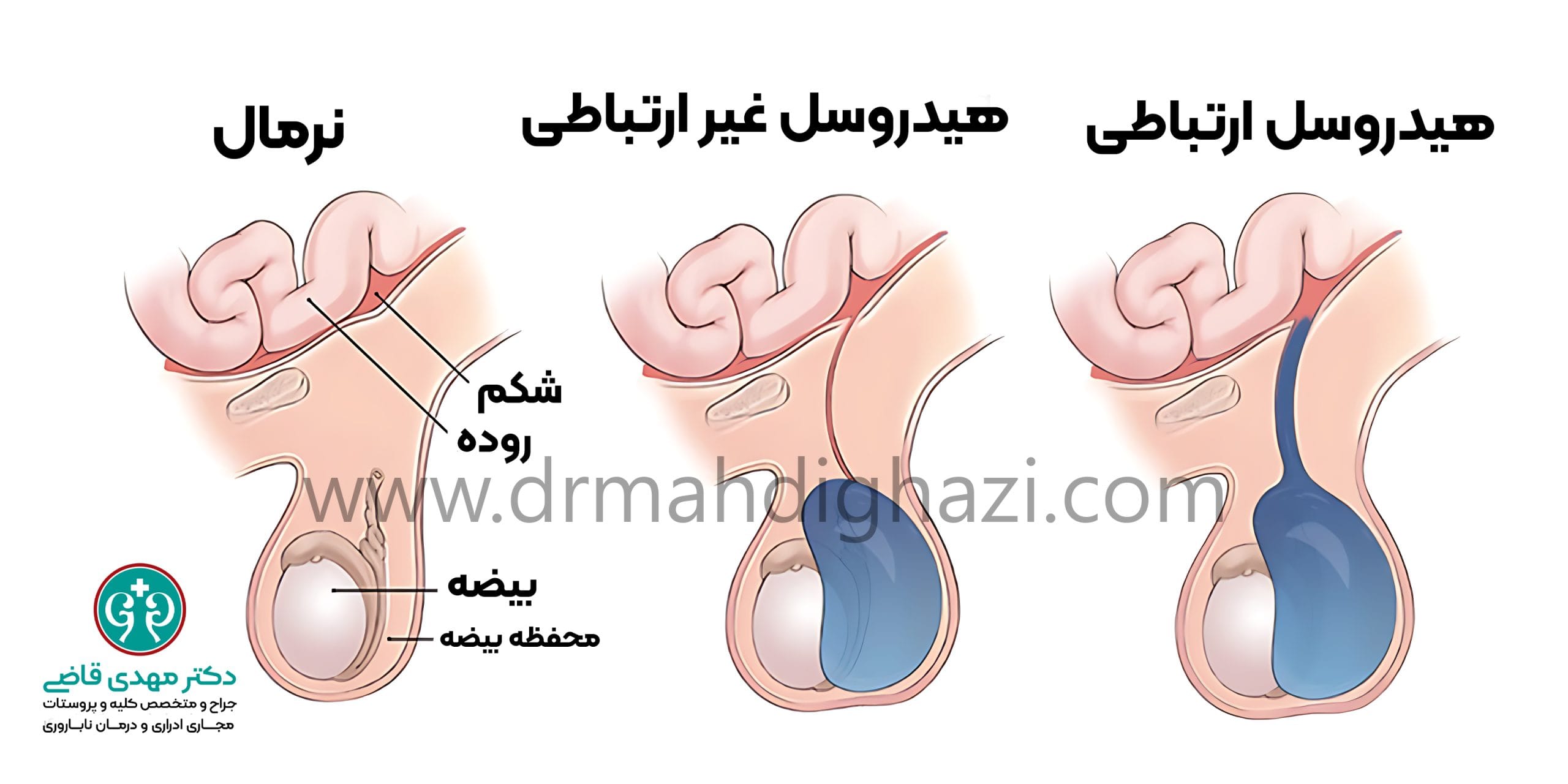دکتر قاضی-هیدروسل: بررسی انواع، علل، تشخیص و روش‌های درمان