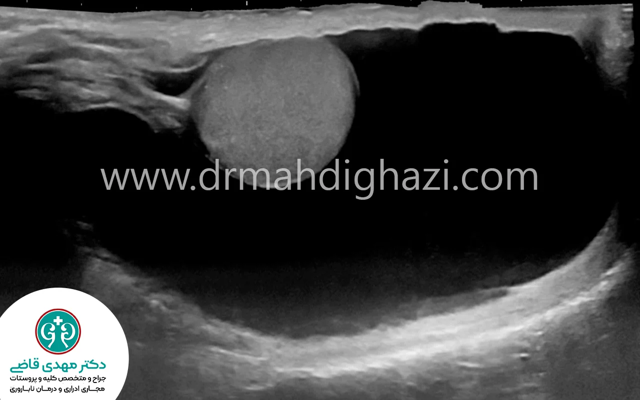 دکتر قاضی - هیدروسل تشخیص درمان و بررسی علل