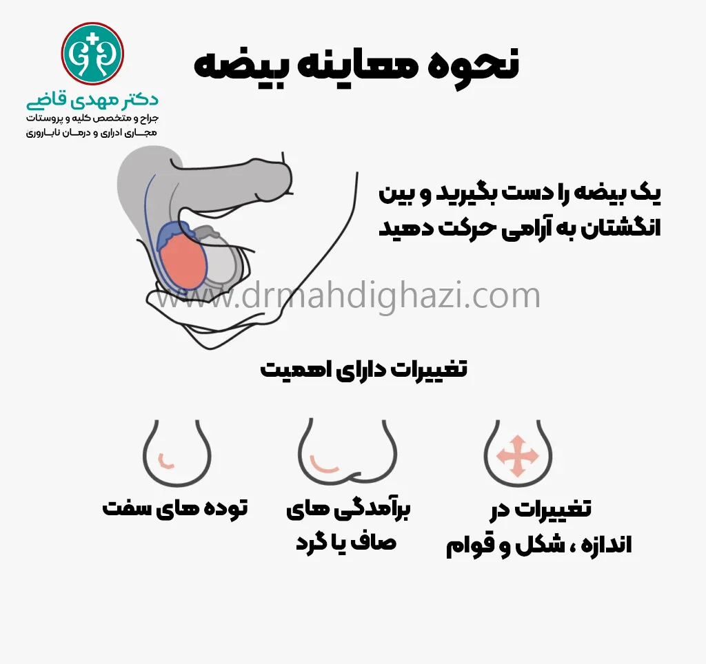 دکتر قاضی-علائم اسپرماتوسل