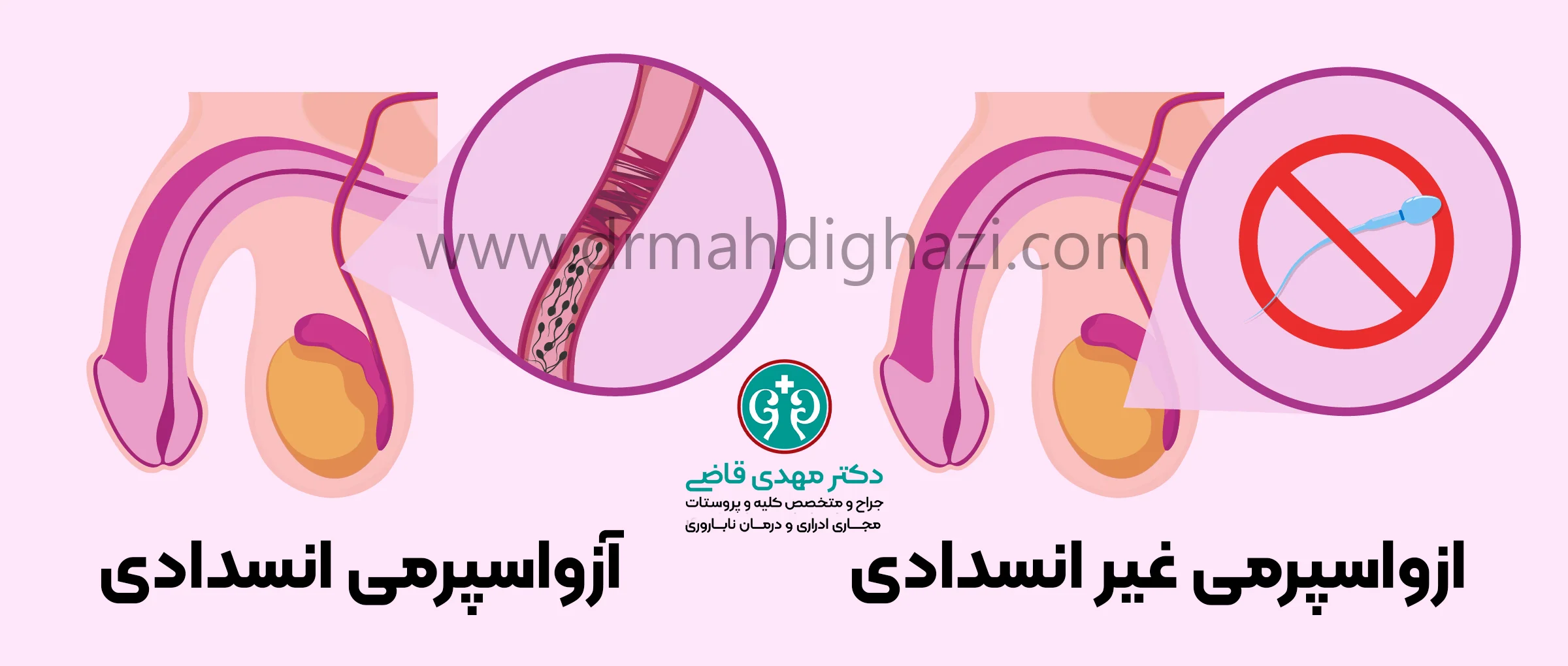 دکتر قاضی - تزریق اسپرم به داخل سیتوپلاسم