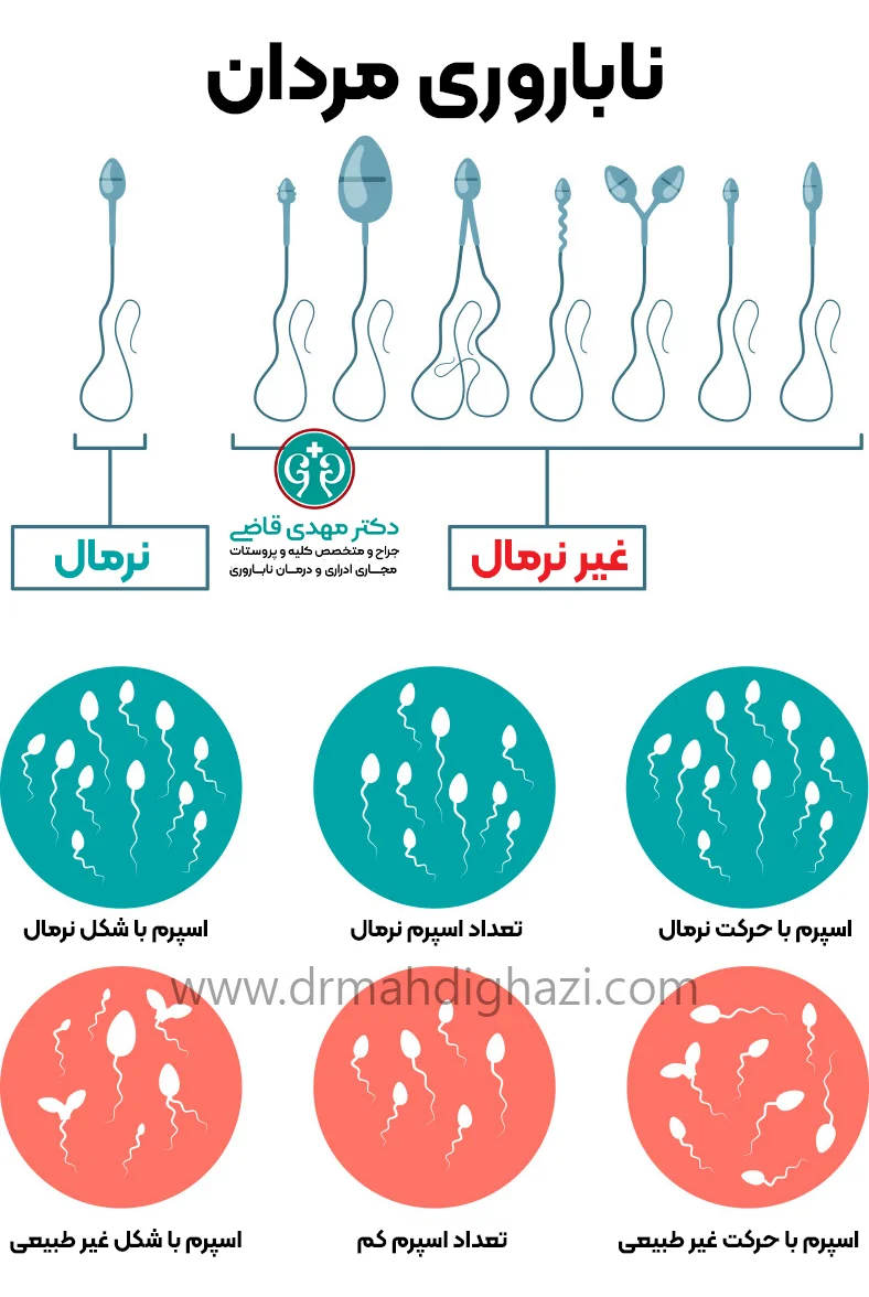دکتر قاضی -ناباروری مردان