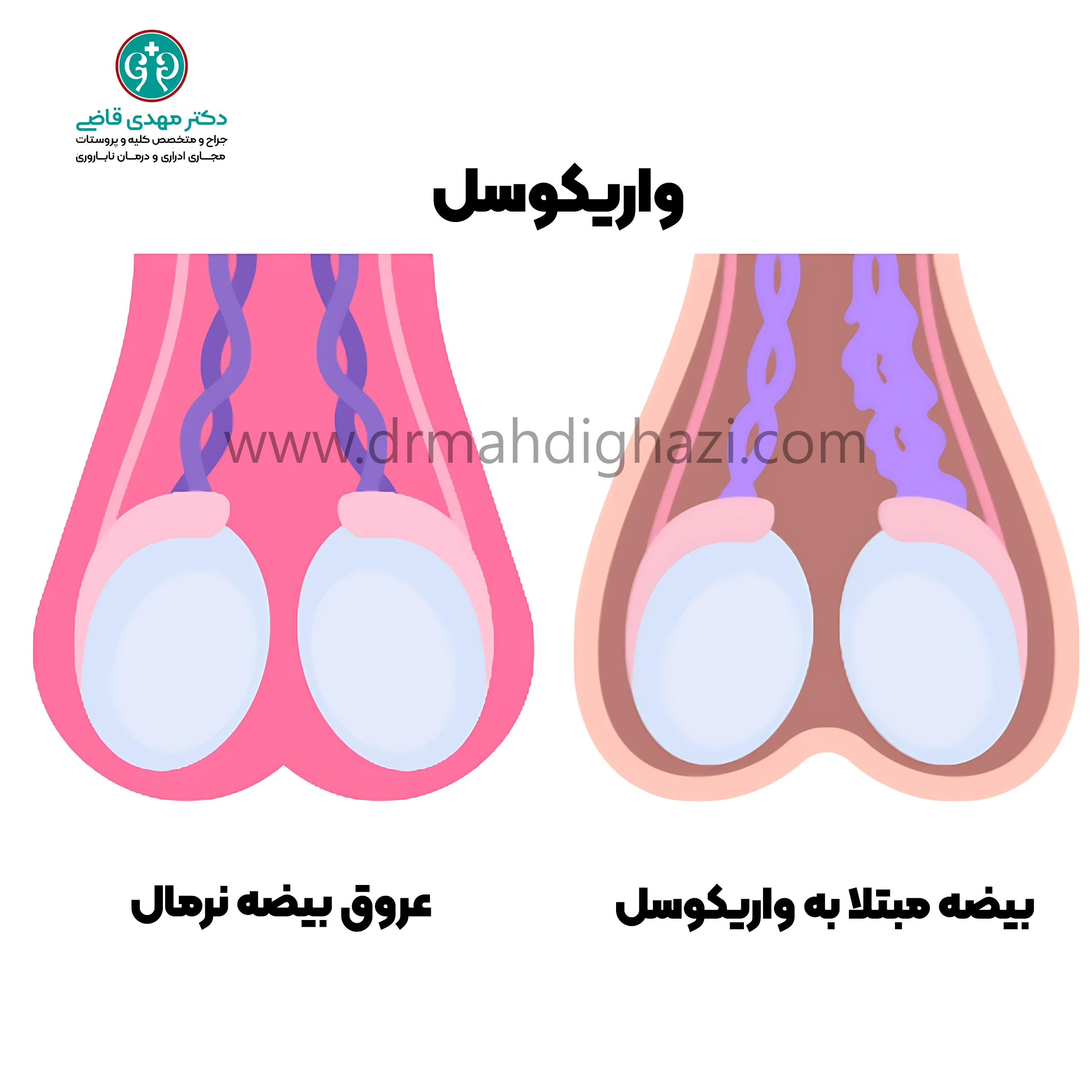 دکتر قاضی-علل ناباروری مردان -درمان واریکوسل