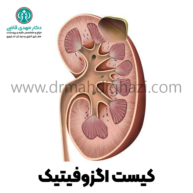 دکتر قاضی-کیست کلیه