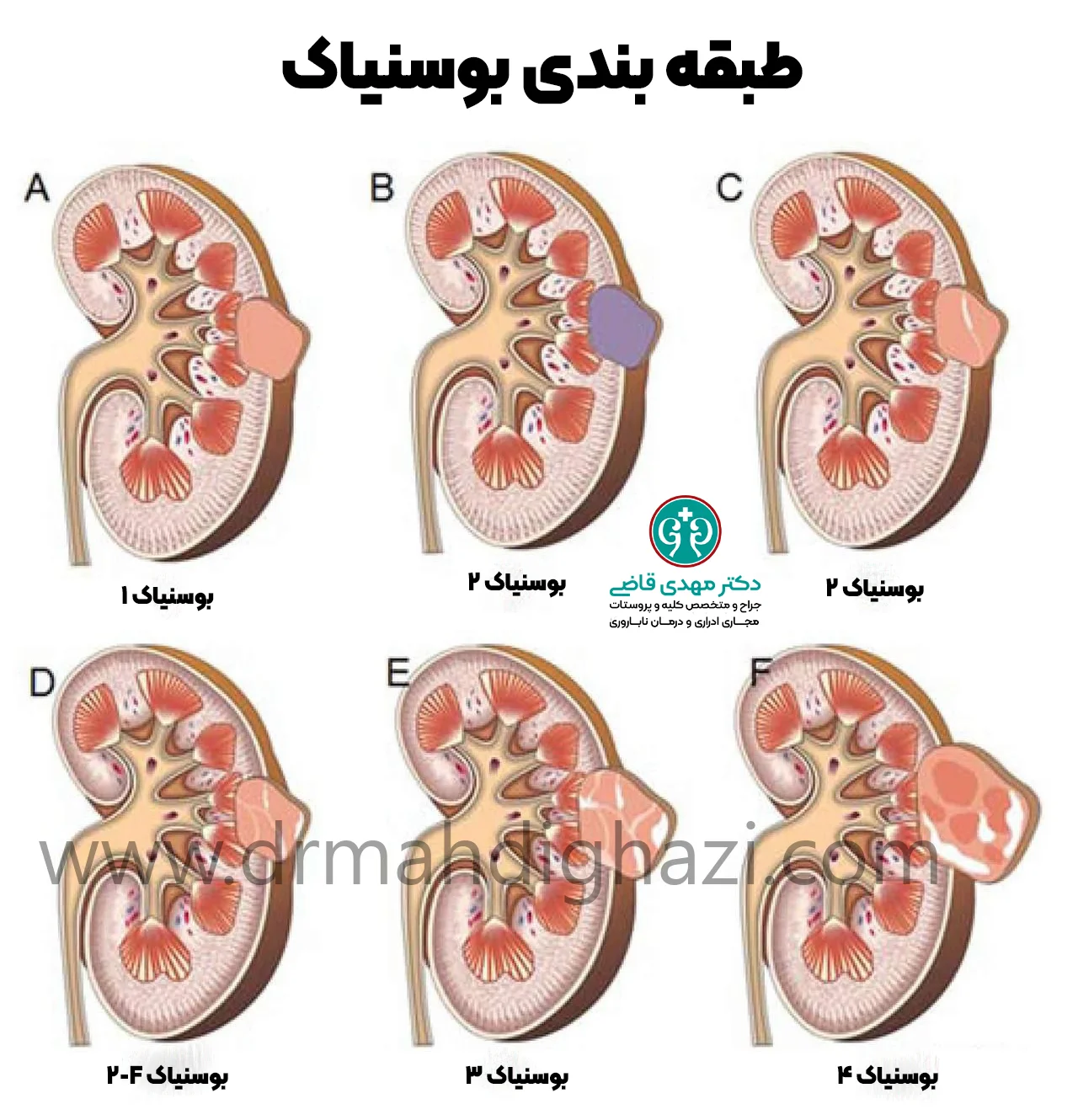 دکتر قاضی- کیست‌های کلیوی