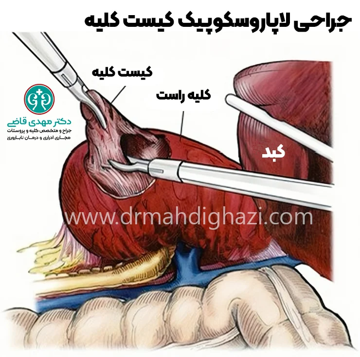 دکتر قاضی-درمان کیست کلیه