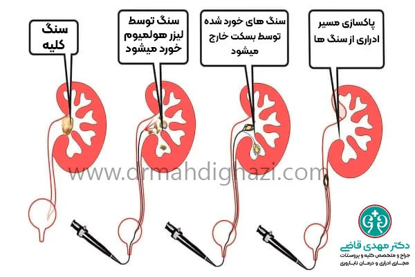 دکتر قاضی-سنگ کلیه