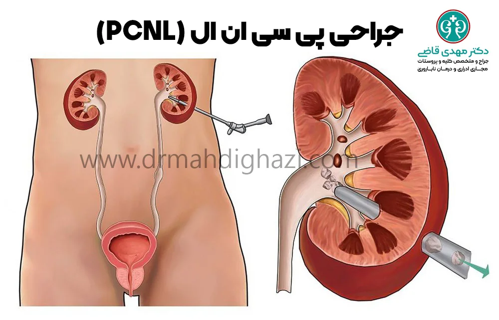 دکتر قاضی-کیست کلیه: علل، علائم، تشخیص و روشهای درمان