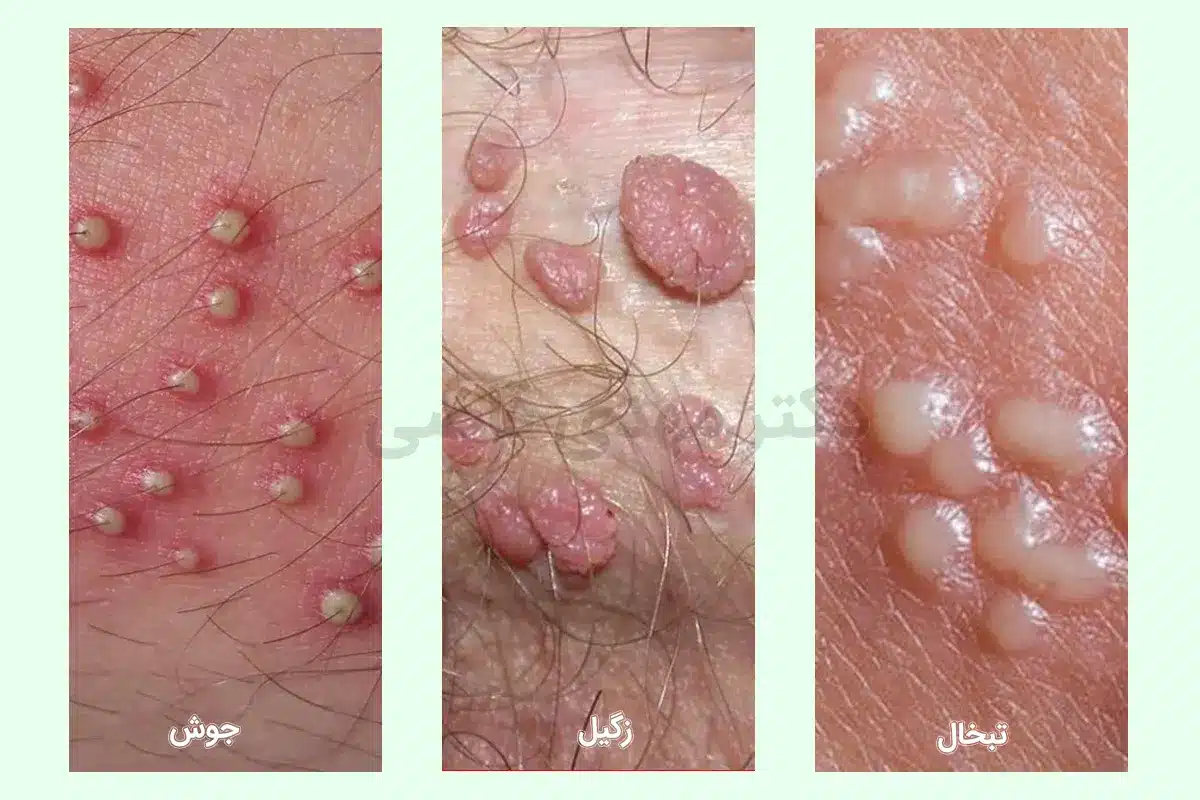 تفاوت زگیل تناسلی با جوش و تبخال