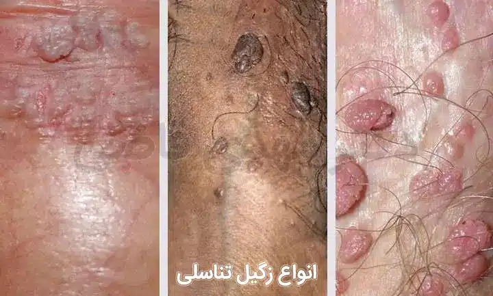 انواع زگیل تناسلی