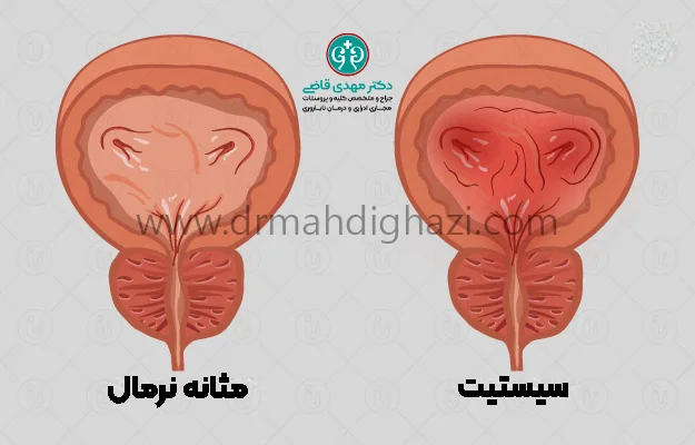 دکتر قاضی-سیستیت چیست؟ تشخیص و درمان