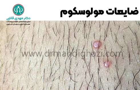 دکتر قاضی-مولوسکوم تناسلی درمان پیشگیری علائم