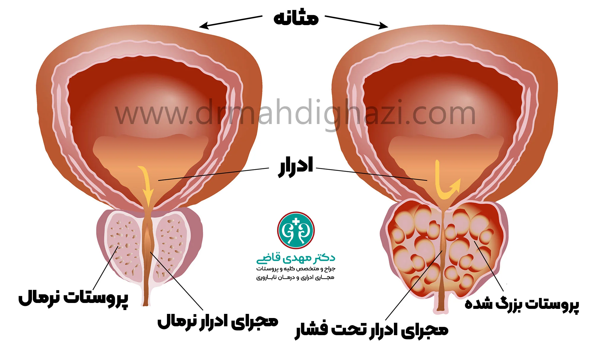 دکتر قاضی-هایپرپلازی خوش خیم پروستات BPH