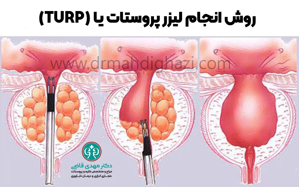 دکتر قاضی-هایپرپلازی خوش خیم پروستات BPH