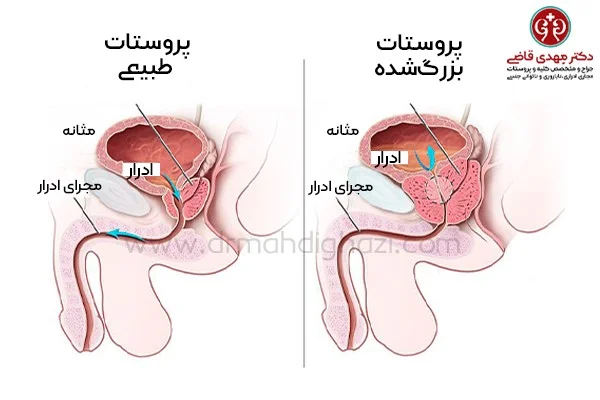 دکتر قاضی-هایپرپلازی خوش خیم پروستات BPH