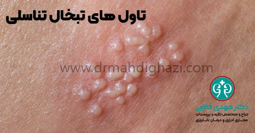 دکتر قاضی- تاول های تبخال تناسلی