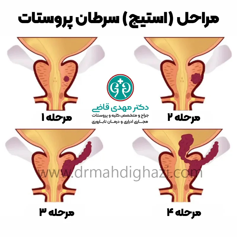 دکتر قاضی مراحل سرطان پروستات