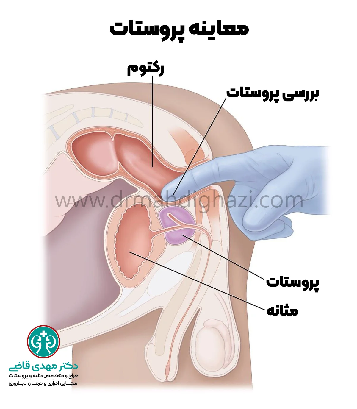 دکتر قاضی- معاینه پروستات