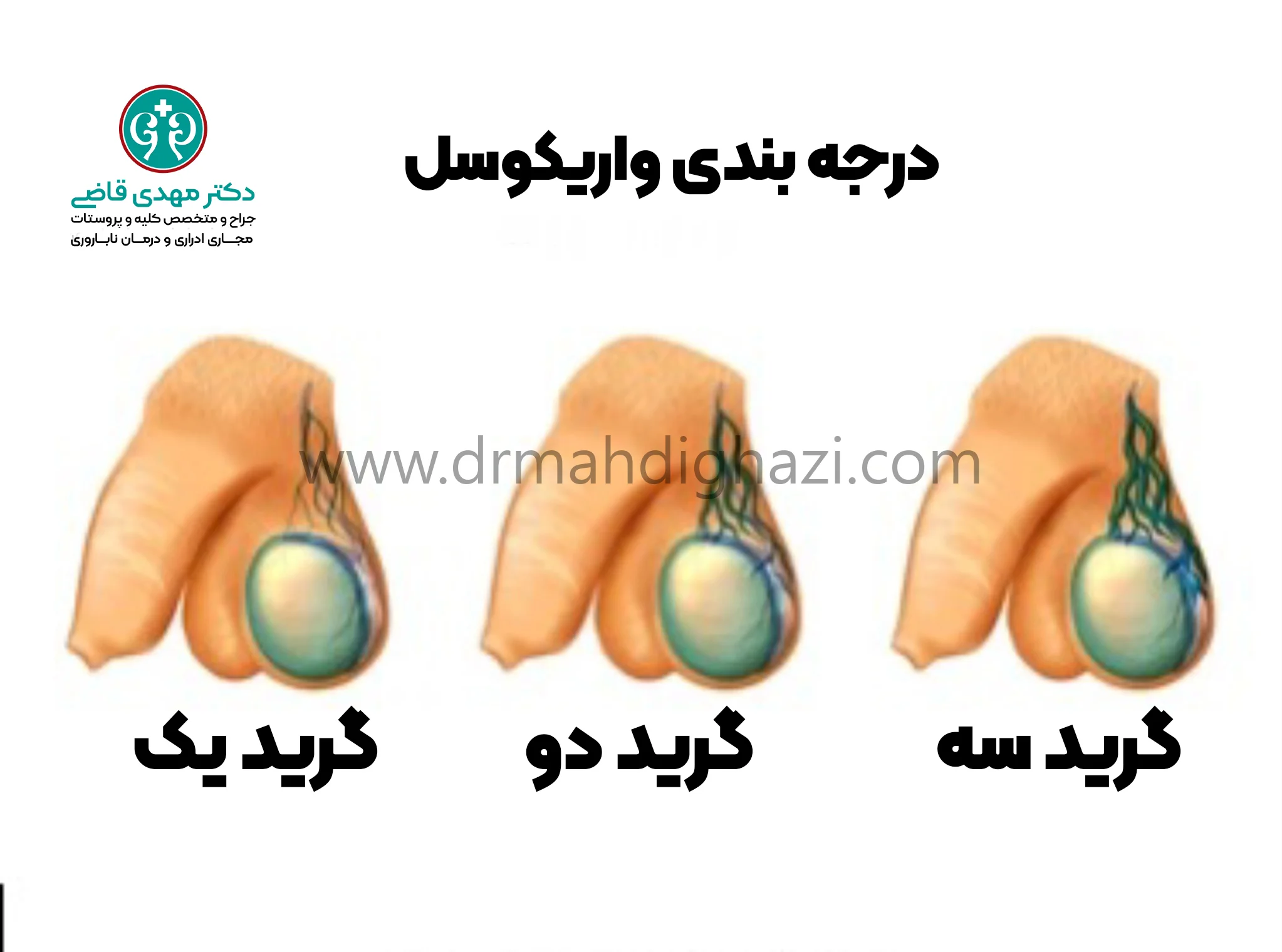 دکتر قاضی - درجه بندی واریکوسل