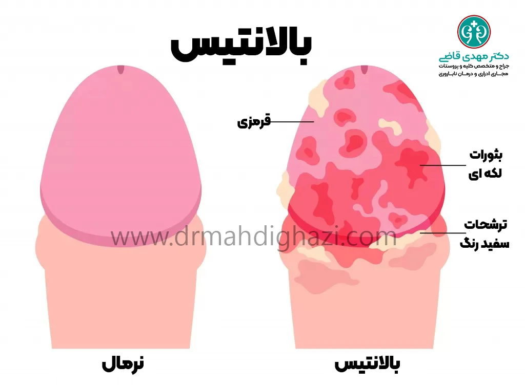 دکتر قاضی- بالانیت قارچی