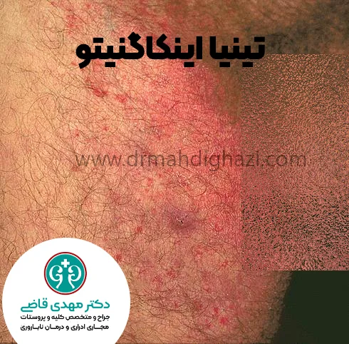 دکتر قاضی- تینیا اینکاگنیتو