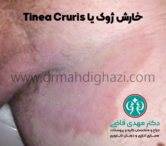 دکتر قاضی- خارش ژوک