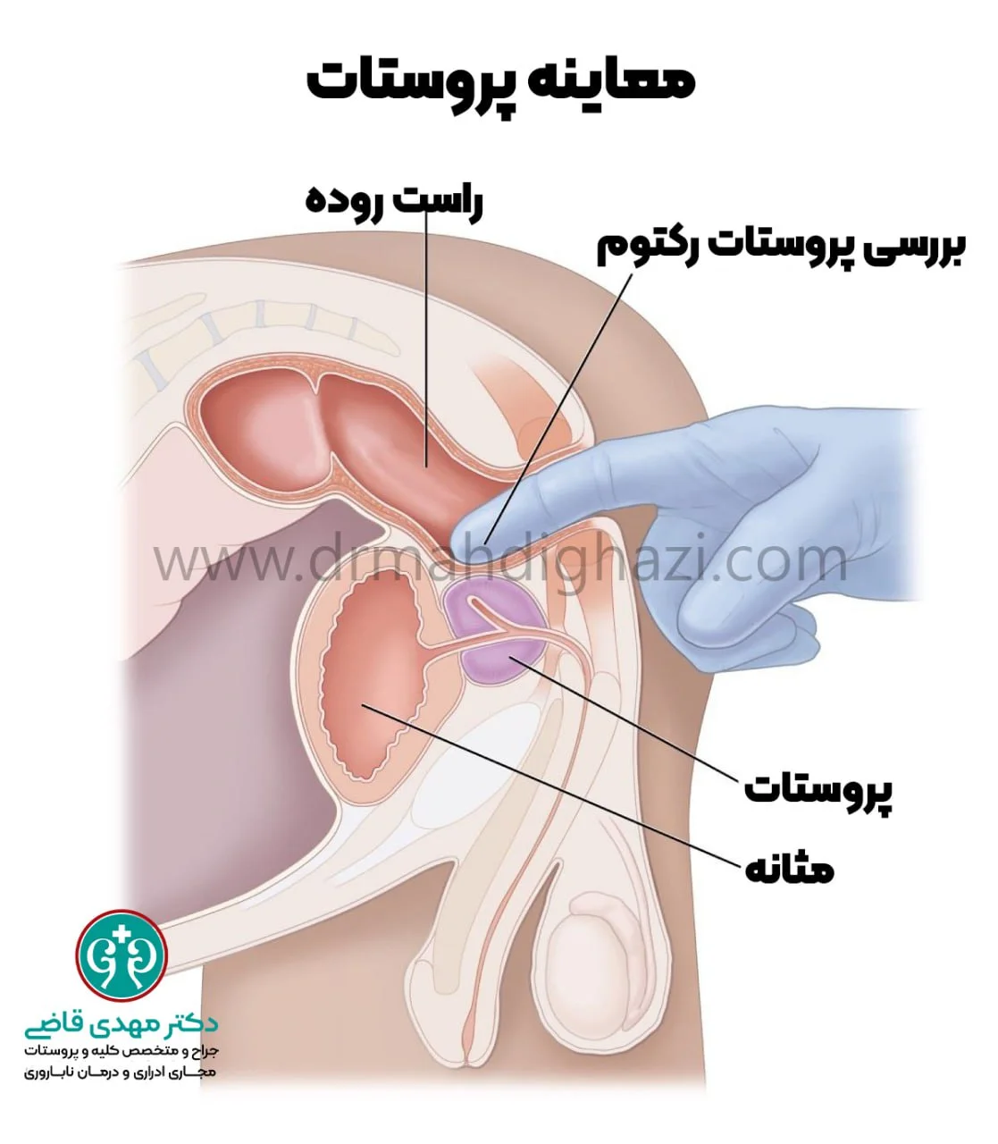 دکتر قاضی- معاینه پروستات
