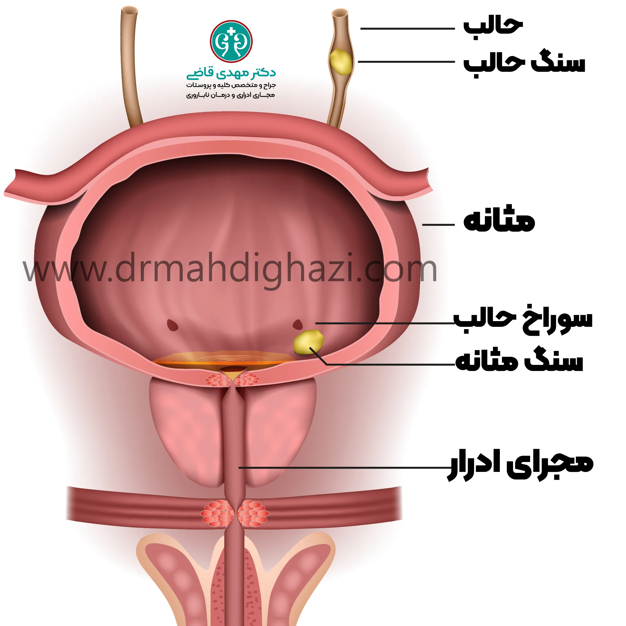 دکتر قاضی- نحوه تشخیص سنگ مثانه
