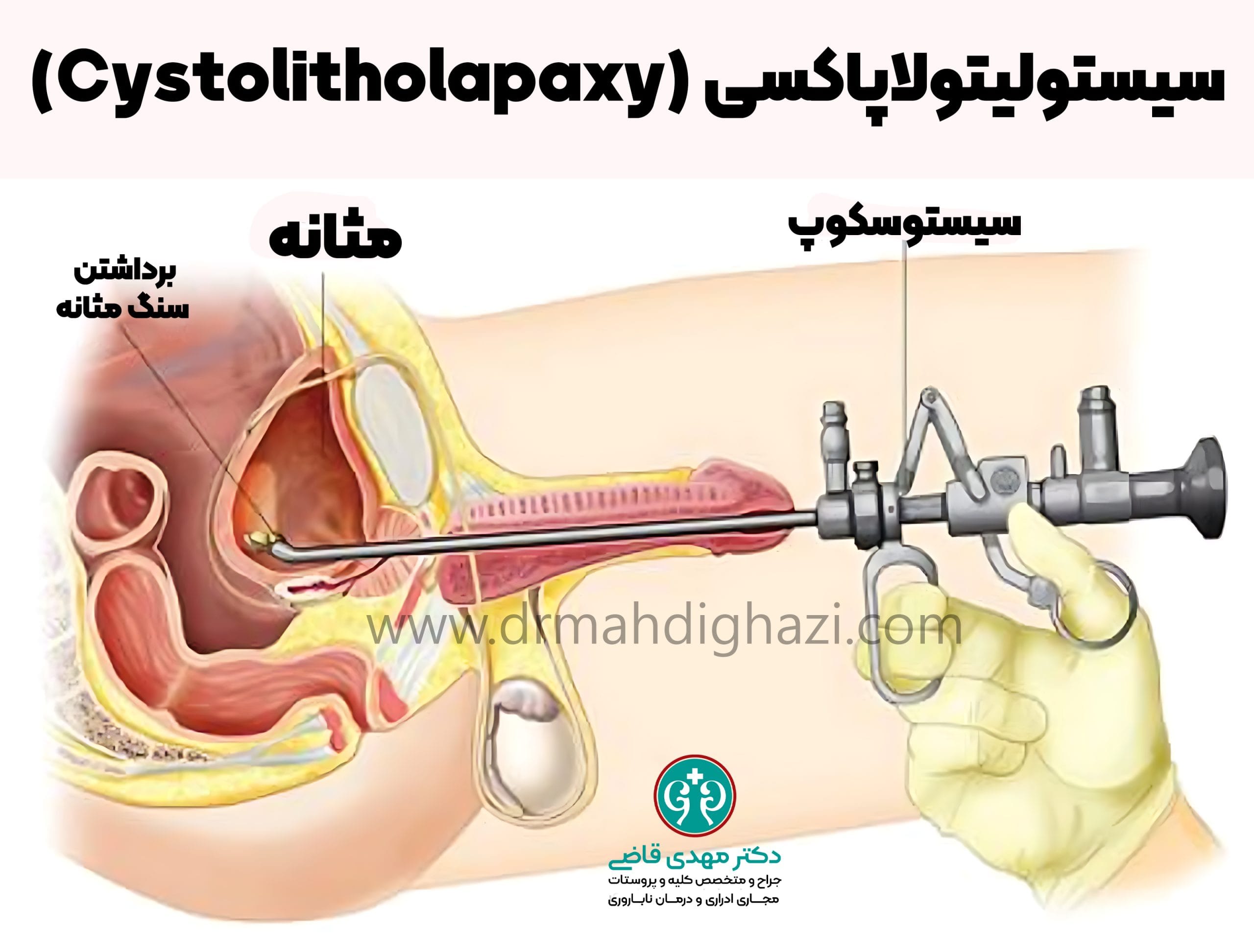 دکتر قاضی - درمان سنگ مثانه