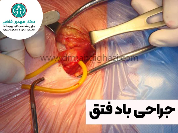 دکتر قاضی- جراحی باد فتق