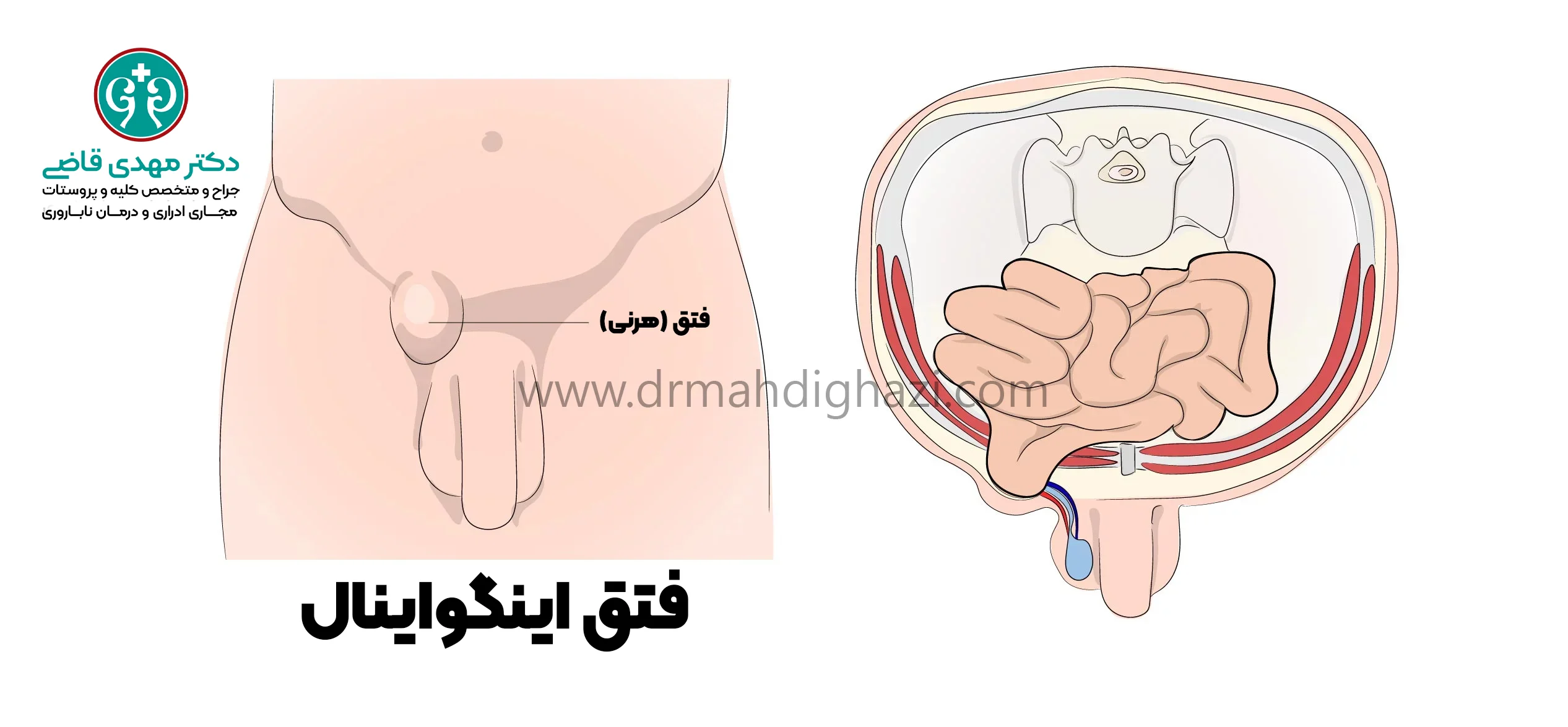 دکتر قاضی-هرنی اینگوینال
