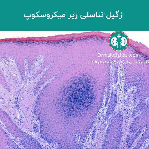 تصویر میکروسکوپی نوری از یک پاپیلومای ناشی از ویروس پاپیلومای انسانی (HPV) که در آن لایه گرانولوزوم حاوی مقدار زیادی گرانولهای کراتوهیالین (هیپرگرانولوزیس) است. همچنین، درم (لایه
