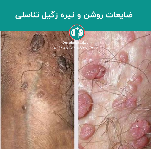 تصویر زگیل های تناسلی روشن و تیره در ناحیه تناسلی مردانه